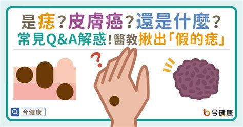 身體長誌|是痣or皮膚癌？醫「1張圖秒對照」 長這2部位最危險